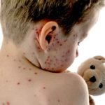 হাম ও উপসর্গ নিয়ে আরও ৮ শিশুর মৃত্যু