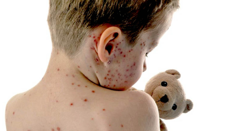 হাম ও উপসর্গ নিয়ে আরও ৮ শিশুর মৃত্যু