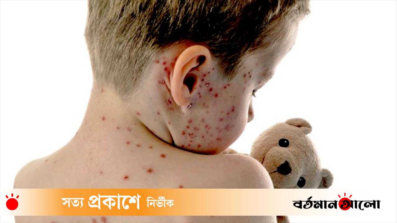 হাম ও উপসর্গ নিয়ে আরও ৮ শিশুর মৃত্যু